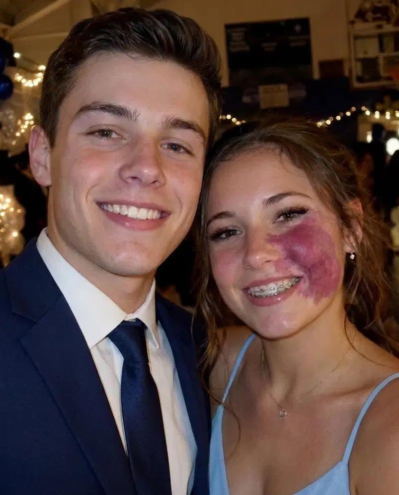 Only one boy asked me to prom because no one else wanted to go with me because of the birthmark on my face — everyone laughed until police officers walked into the gym.